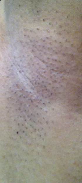 July 3, 2014: I decided to not shave for that week, and I noted that my armpits were not bushy at all! 