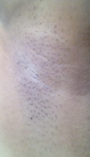 July 17, 2014: Freshly lasered armpit reveals diminished darkness, and some empty bald spots