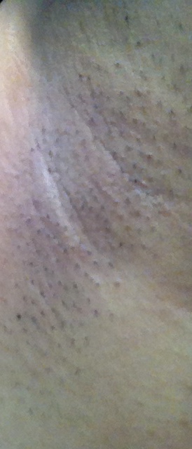 July 8, 2014: The regrowth is definitely slower. I only lasered my armpits twice at this point.