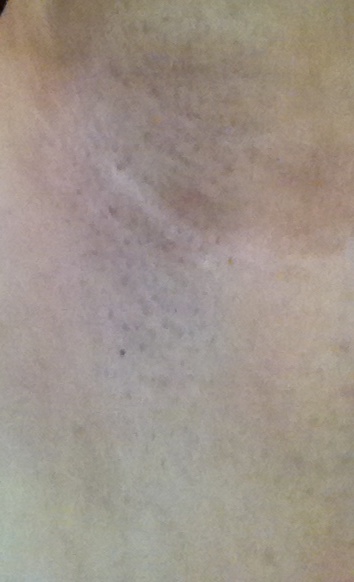 After shaving my armpit, and wiping away moisture, I lasered for the first time using level 1 intensity.